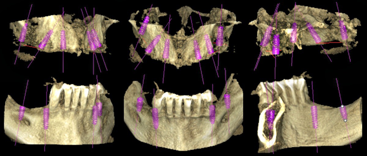 imágenes de un Escaner 3D para colocar implantes dentales