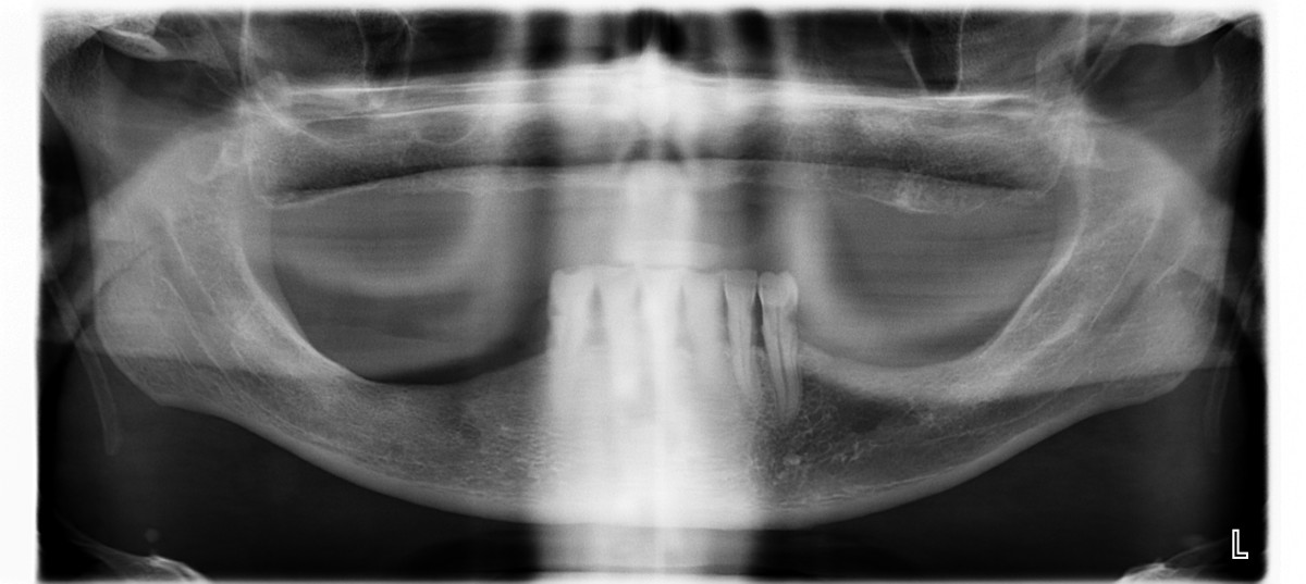 ortopantomografía para los pasos previos a colocar un implante