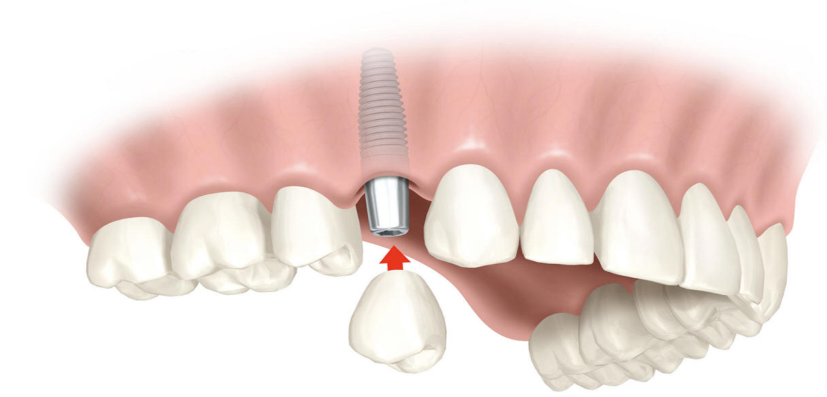 servicio-implantes-dentales-2-1200x576.png