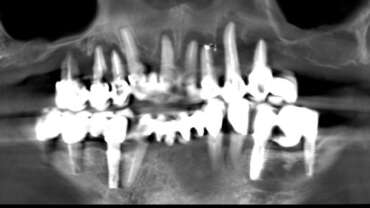 implantes dentales complicados