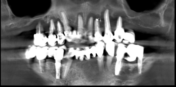 implantes dentales complicados