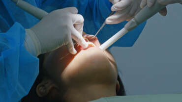 edad minima para un implante dental