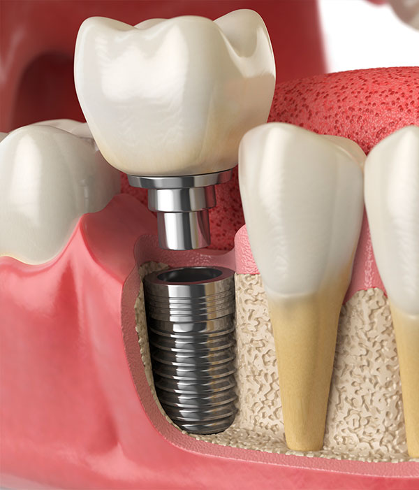 implante dental corona
