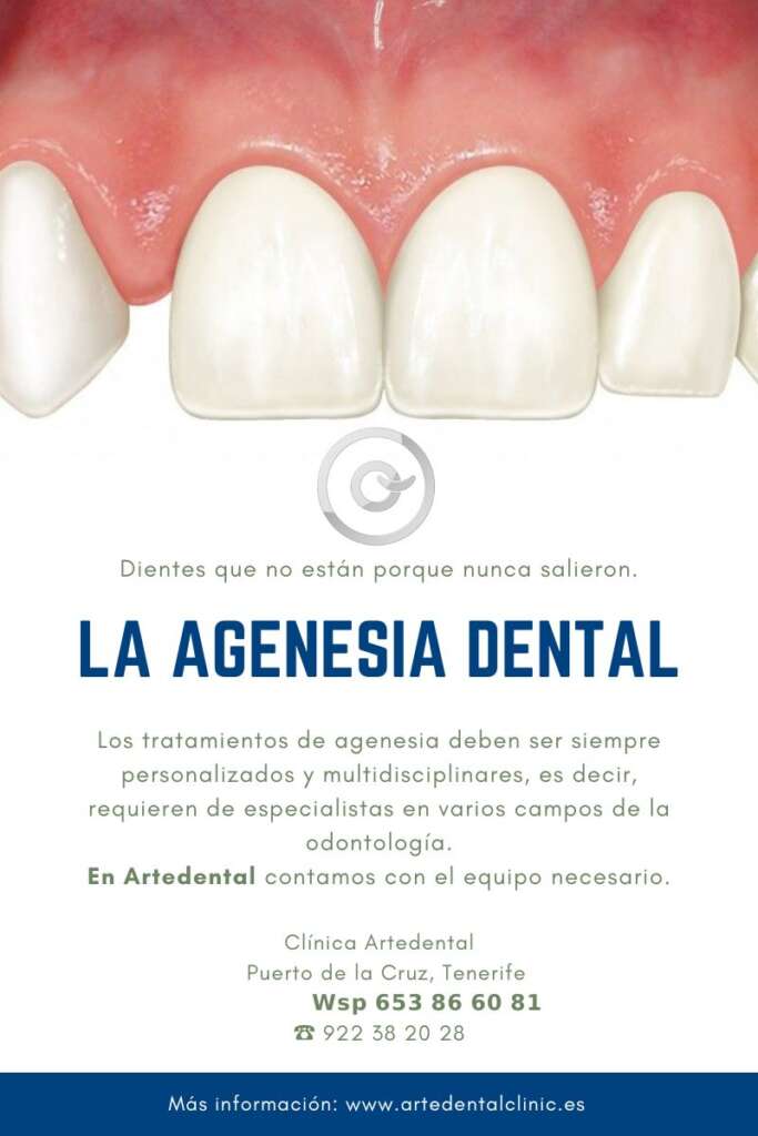 Agenesia dental en la clínica dental Artedental en Tenerife. Puerto de la cruz