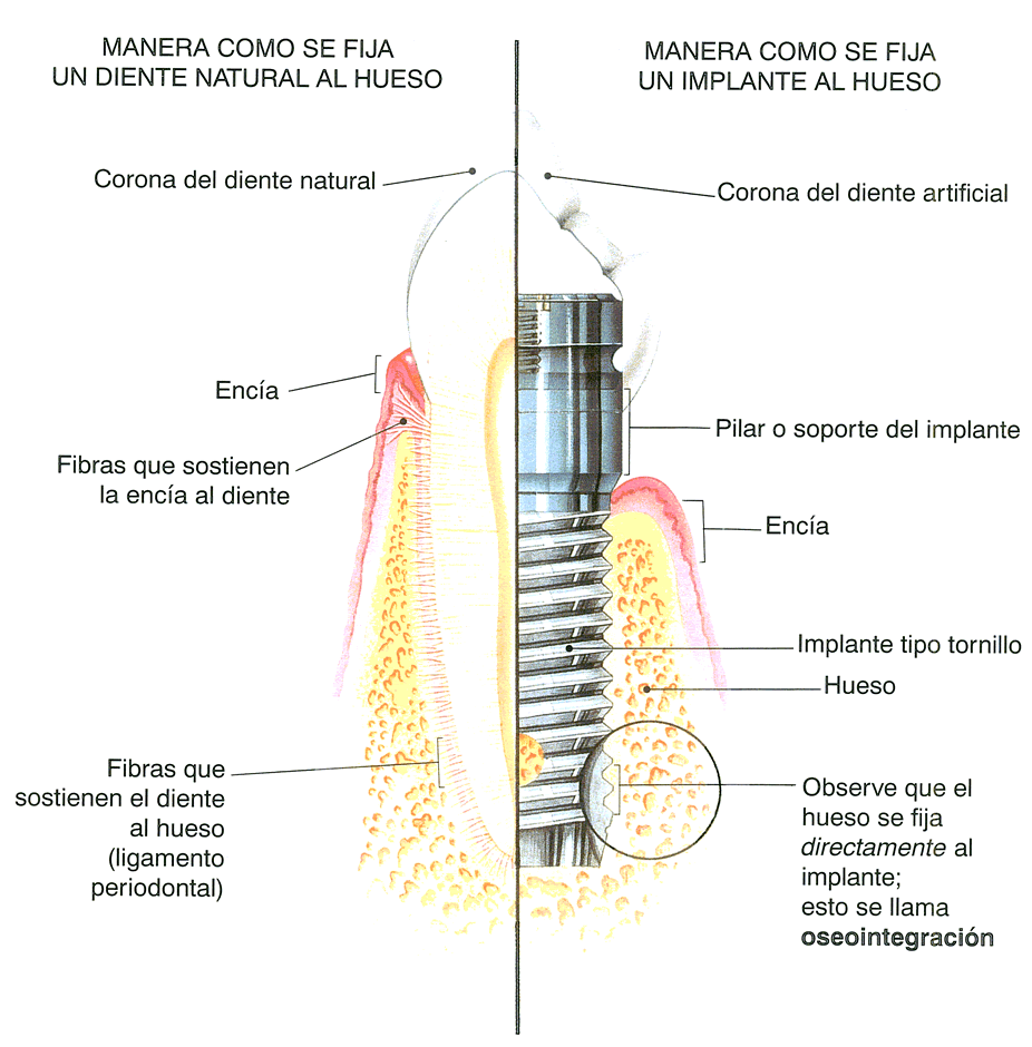 implante, glosario de términos