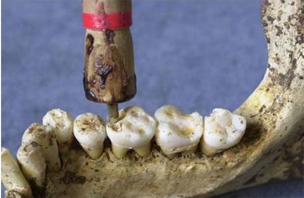 primeros tratamientos dentales conocidos. Tenerife