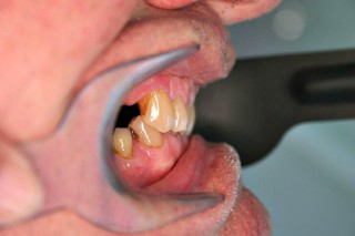 Bruxism. Grinding of the teeth