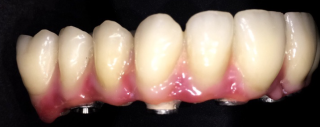 Prosthesis