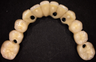 ArtOn 4 prosthesis