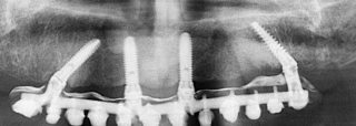 The materials used are PMMA teeth, titanium and composite.