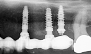The materials used are PMMA teeth, titanium and composite.