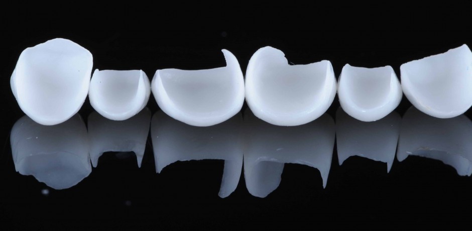 carillas dentales sonrisas de cine artedental carillas dentales