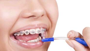 higiene dental con brackets