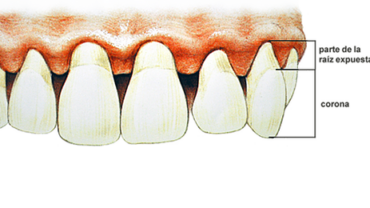 vacuna contra la periodontitis