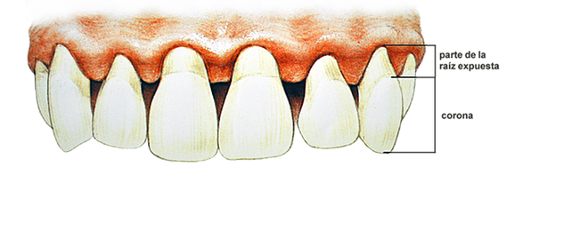 vacuna contra la periodontitis