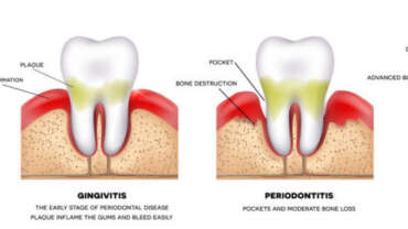 gum inflamation, inflamacion de las encias