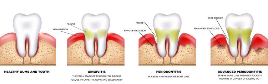 gum inflamation, inflamacion de las encias