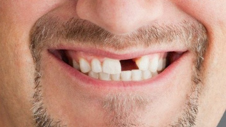 evitar la pérdida de un diente