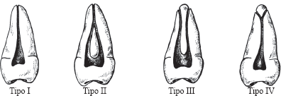 número de conductos dentales Tipos de conductos pulpares