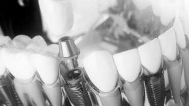 implantes dentales carga inmediata