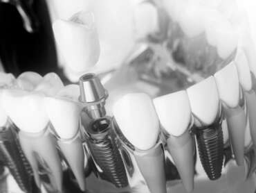 implantes dentales carga inmediata