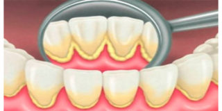 Sarro, causas, consecuencias y soluciones. - ARTEDENTAL