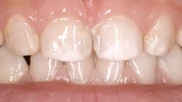 manchas blancas en los dientes