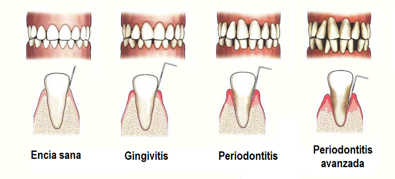 periodoncia Puerto de la Cruz