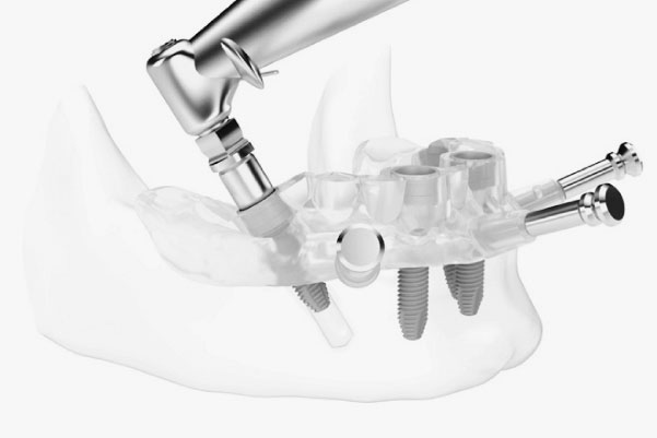 https://www.artedentalclinic.com/wp-content/uploads/2018/01/guiada-corr.jpg