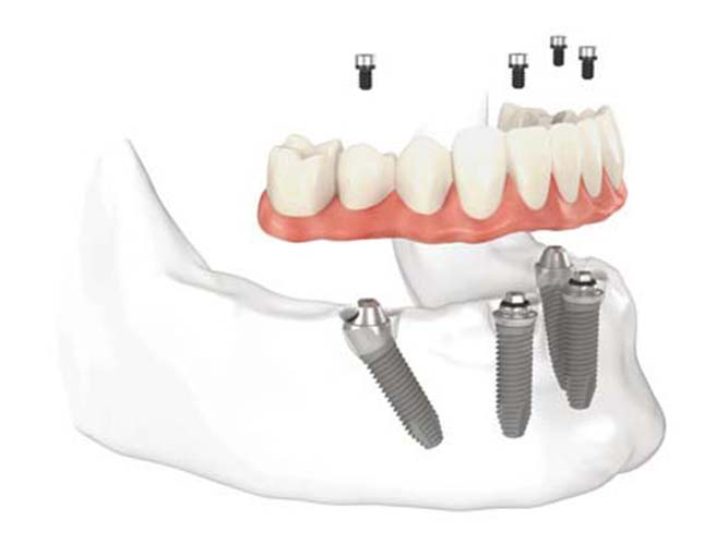 hibridas sobre implantes HYBRIDPROTHESE AUF IMPLANTATEN