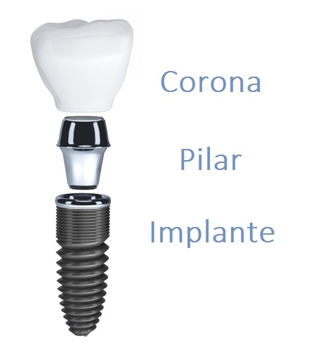 implantes dentales Puerto de la Cruz
