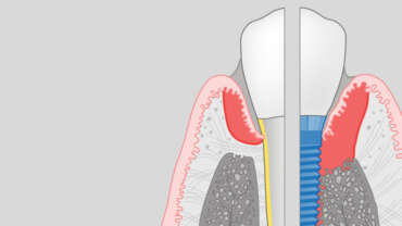 periimplantitis implantes dentales Tenerife