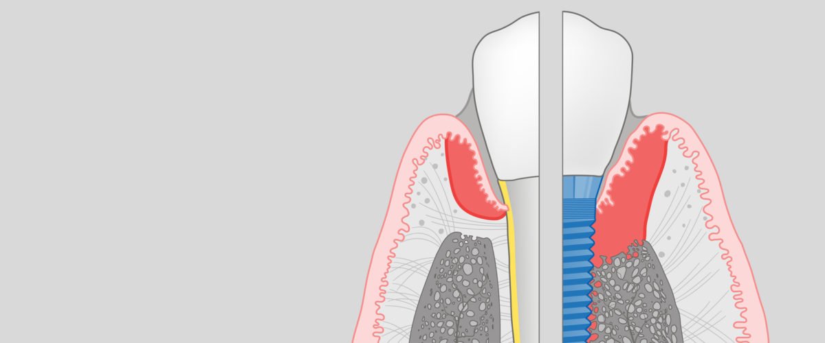 periimplantitis implantes dentales Tenerife