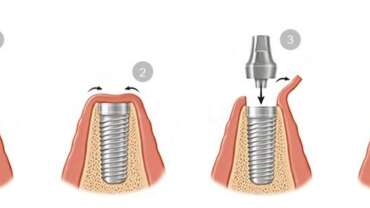 Preguntas de implantes dentales