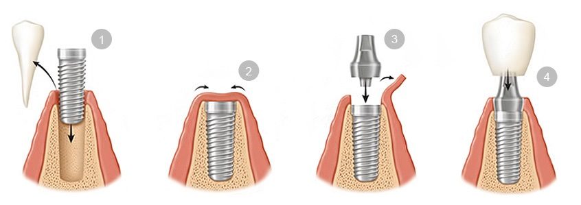Preguntas de implantes dentales