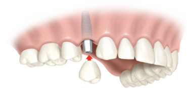 implantes dentales