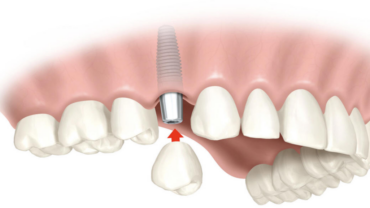 implantes dentales