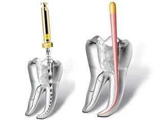 endodoncia duele