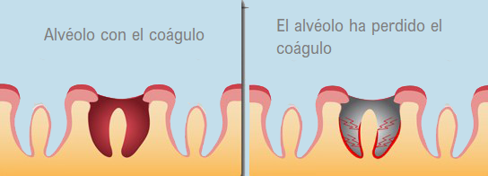 alveolitis seca