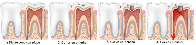 síntomas de la caries. fases de la caries