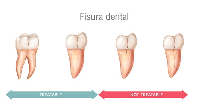 fisura dental