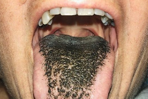 halitosis, lengua negra