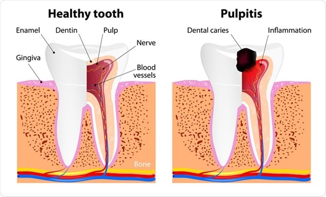 pulpitis dental tenerife  clínica dental Puerto de la cruz