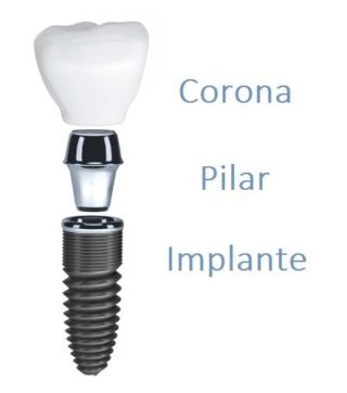 implante dental,pilar,corona