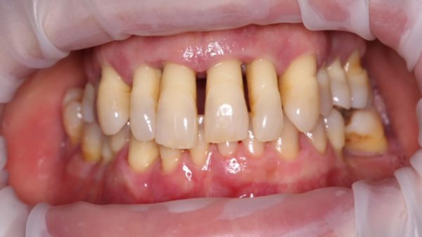 periodontitis, encías retraídas