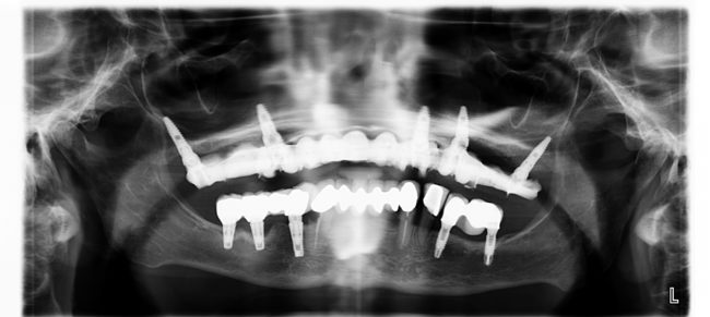 rx final implantes dentales de carga inmediata