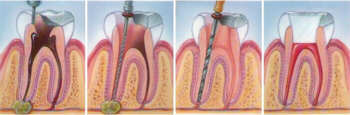 pasos para una endodoncia