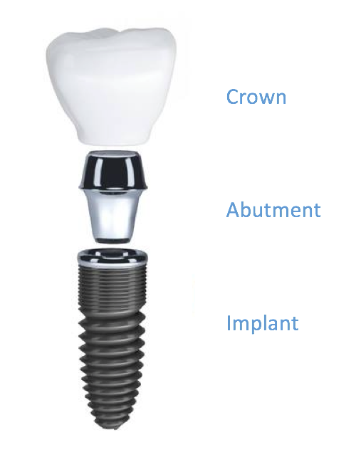 dental implant, dental clinic Tenerife