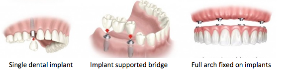 dental implants Puerto de la Cruz