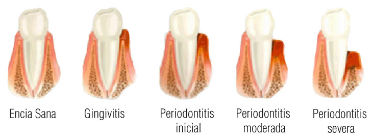 vacuna contra la periodontitis